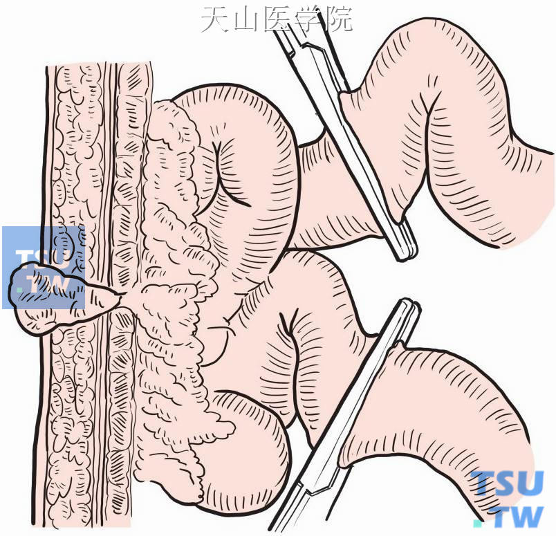 钳夹肠瘘远、近端肠襻