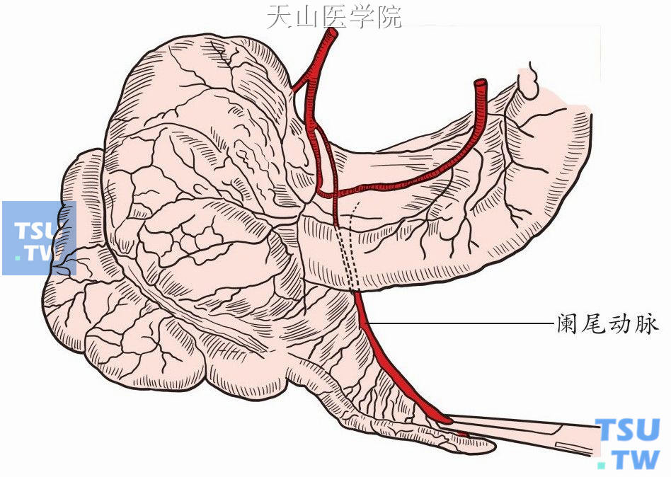 增：阑尾切除手术（阑尾炎）