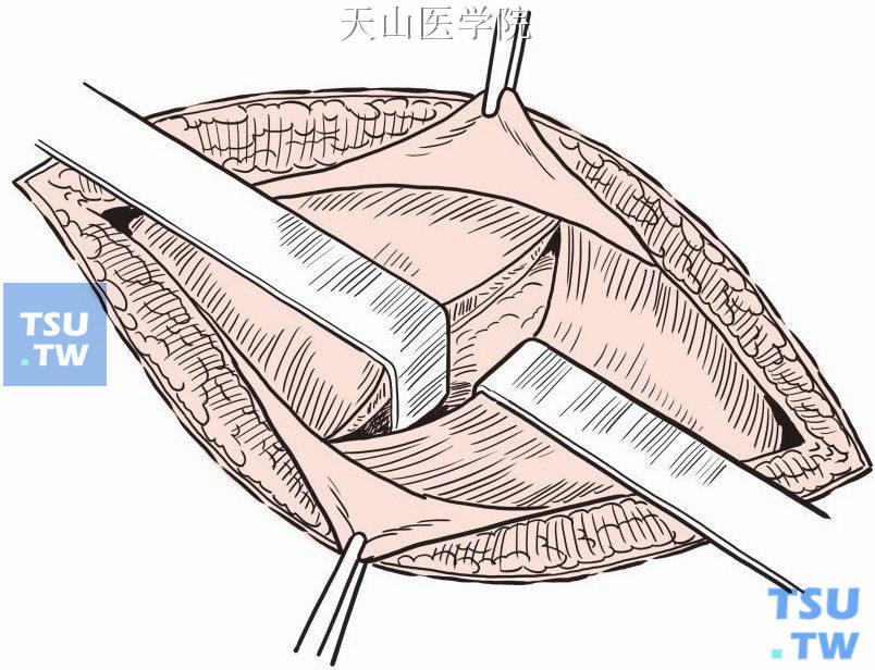 腹壁各层切开