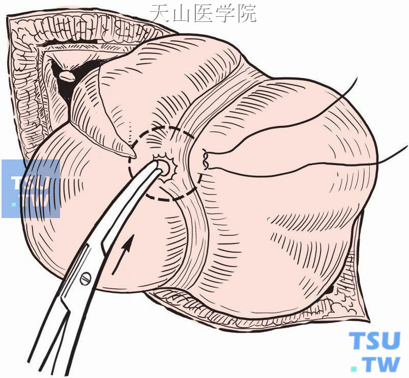 阑尾残端荷包包埋