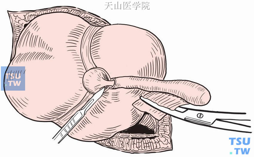盲肠浆肌层和粘膜间分离