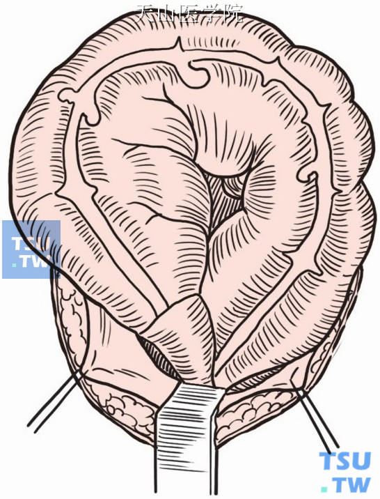 扩张的乙状结肠提出切口外，狭窄的直肠段为病变部位