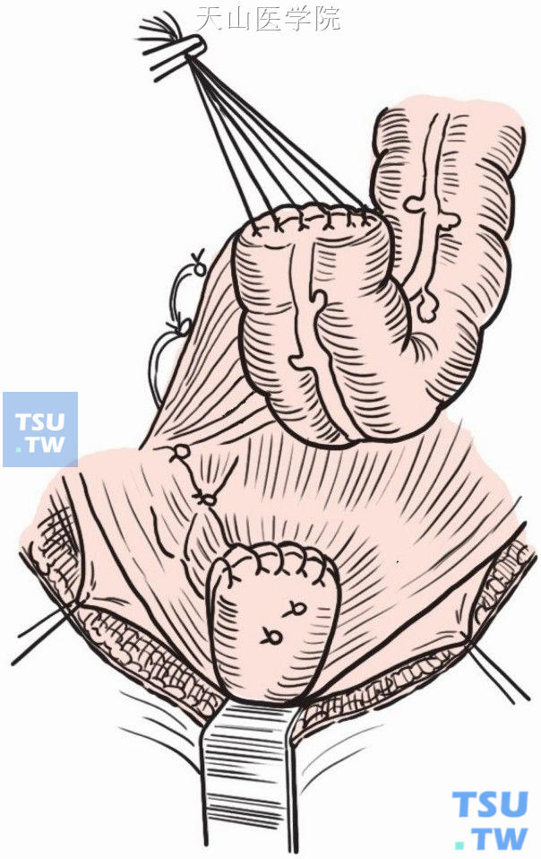 Swenson结直肠拉出切除术
