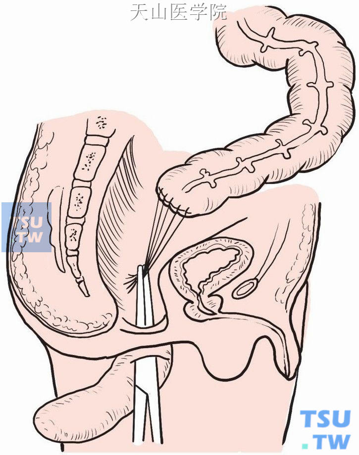 近端结肠经直肠前壁切口拉出