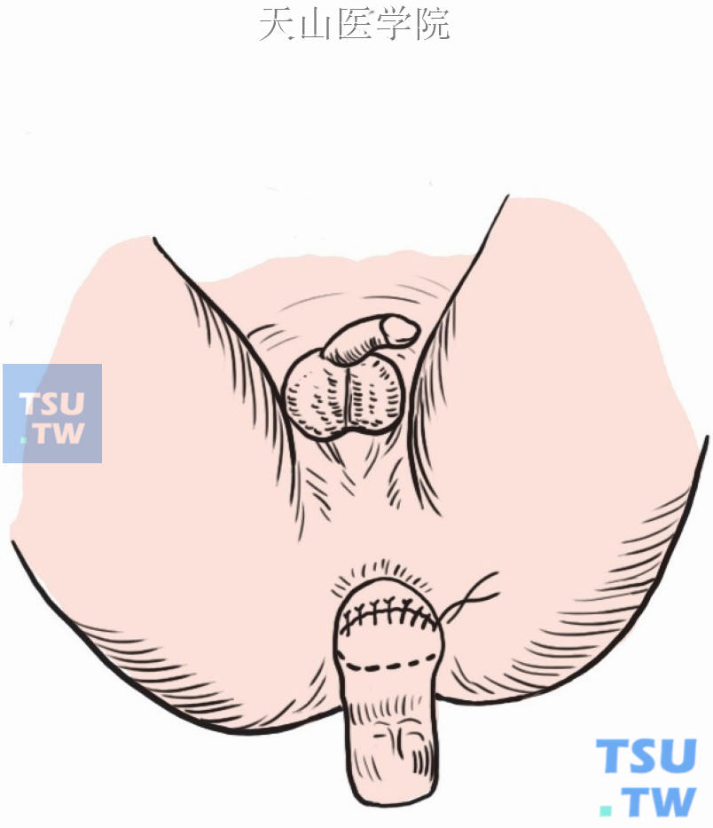 间断缝合内外两个肠管的前半部分浆肌层
