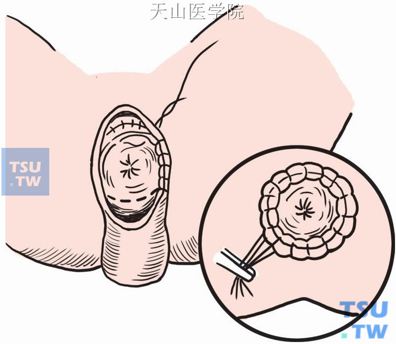 内外肠管的全层间断缝合