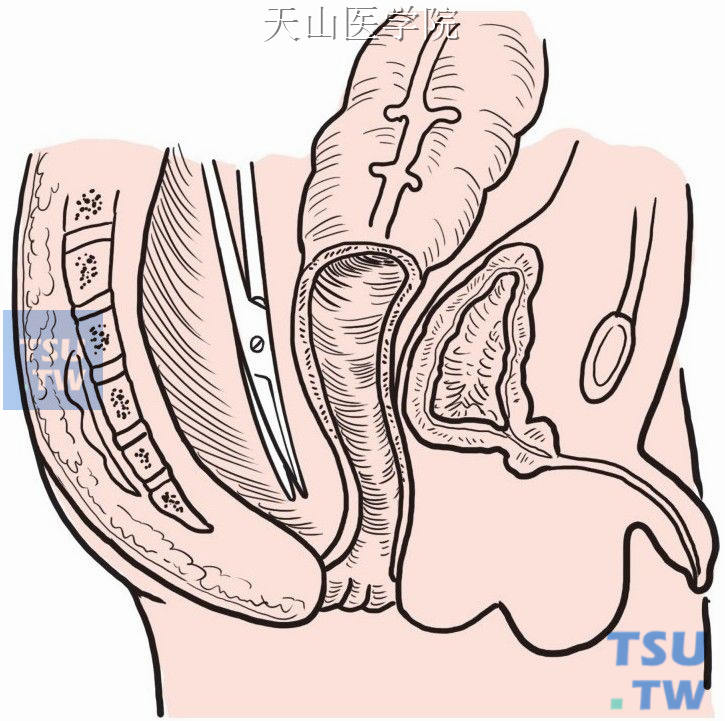 分离直肠后壁至盆腔底部