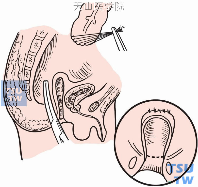 分离外括约肌直至直肠后间隙，与腹部组游离直肠后间隙会师
