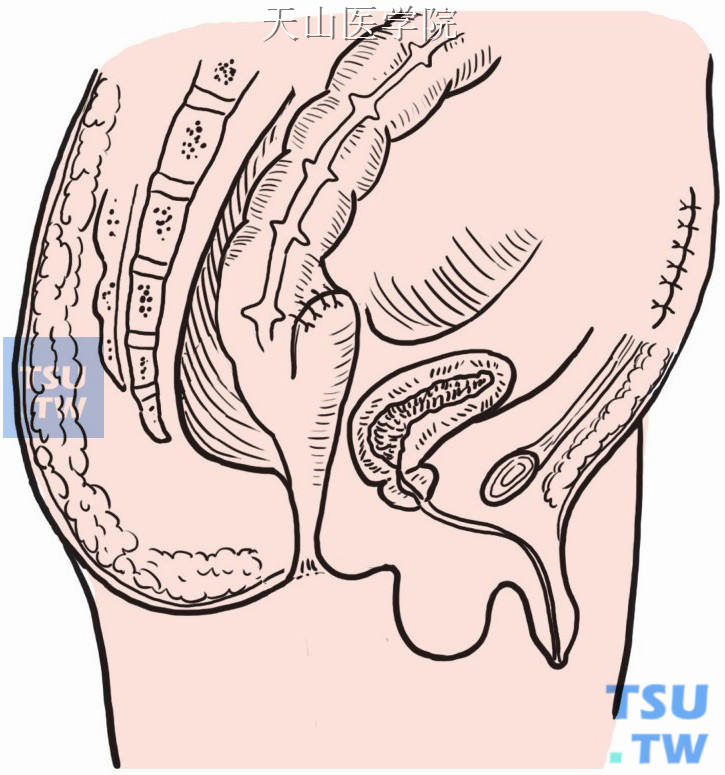 直肠盲端与结肠前壁缝合