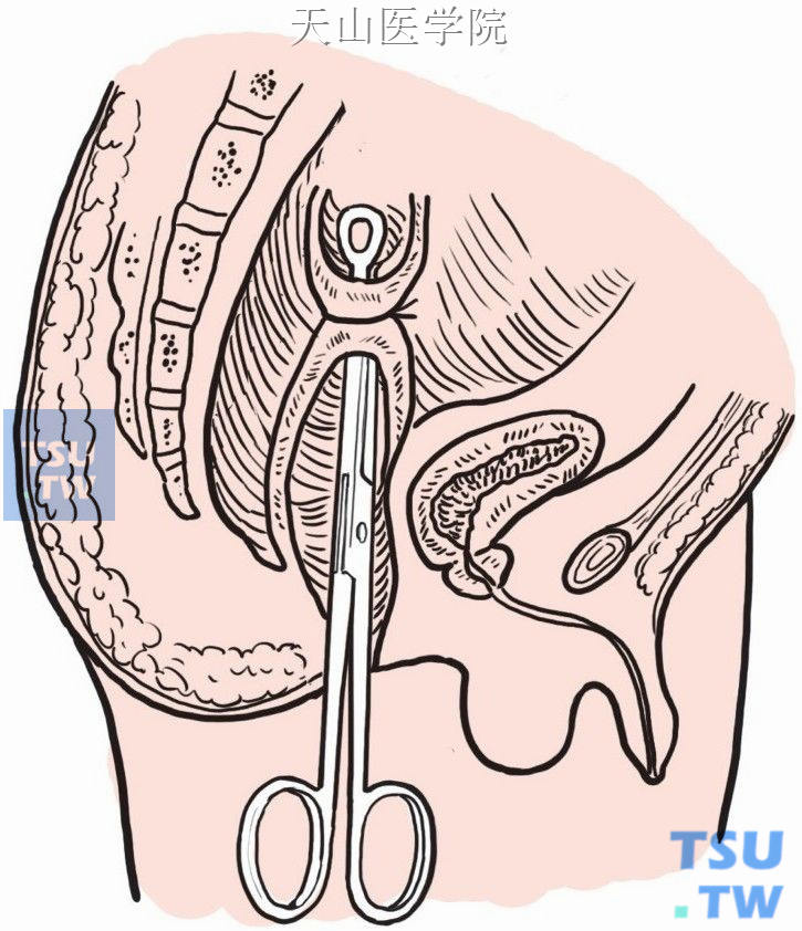 钳夹乙状结肠远端肠壁，腹腔内将肠管紧缚于钳颈部