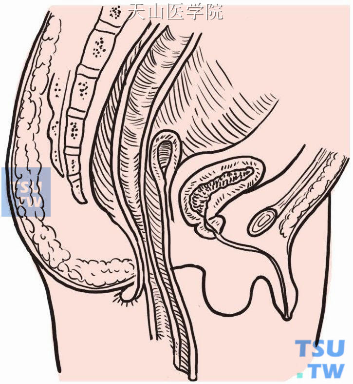 将拉下的结肠与直肠分为前后两半部均等剪开，在齿状线上同一平面切除外翻的直肠和结肠的后半部肠管，两者行间断缝合