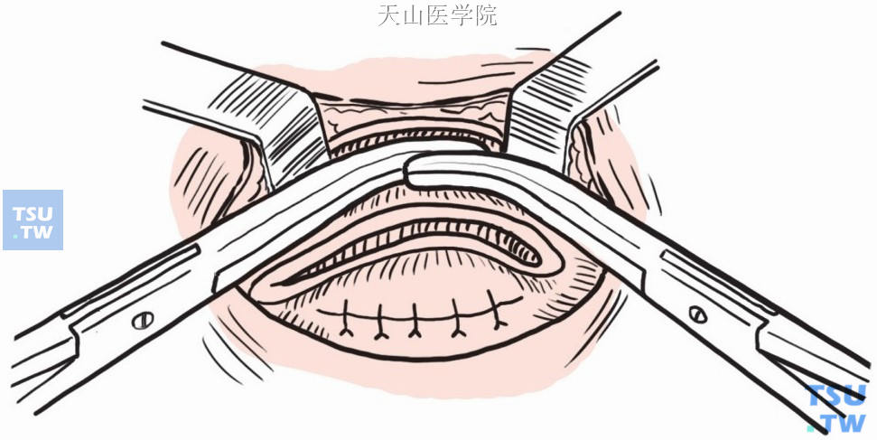 两把Kocher钳钳夹直肠与结肠前壁