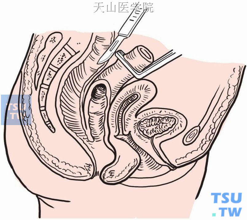 Ikeda直肠后结肠拉出和直肠结肠“Z”形吻合术