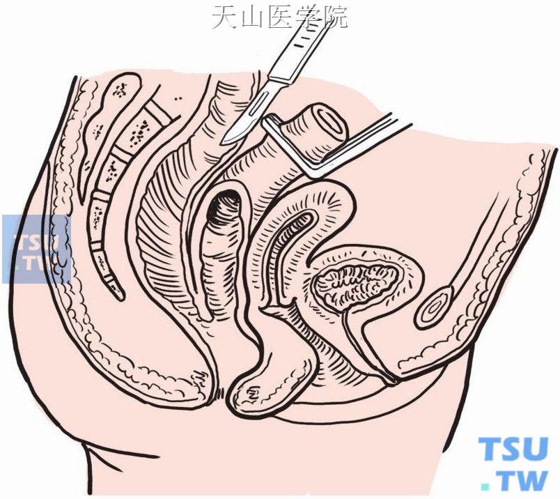 结肠经直肠后间隙拉出，平行于直肠上端横形切开结肠前壁