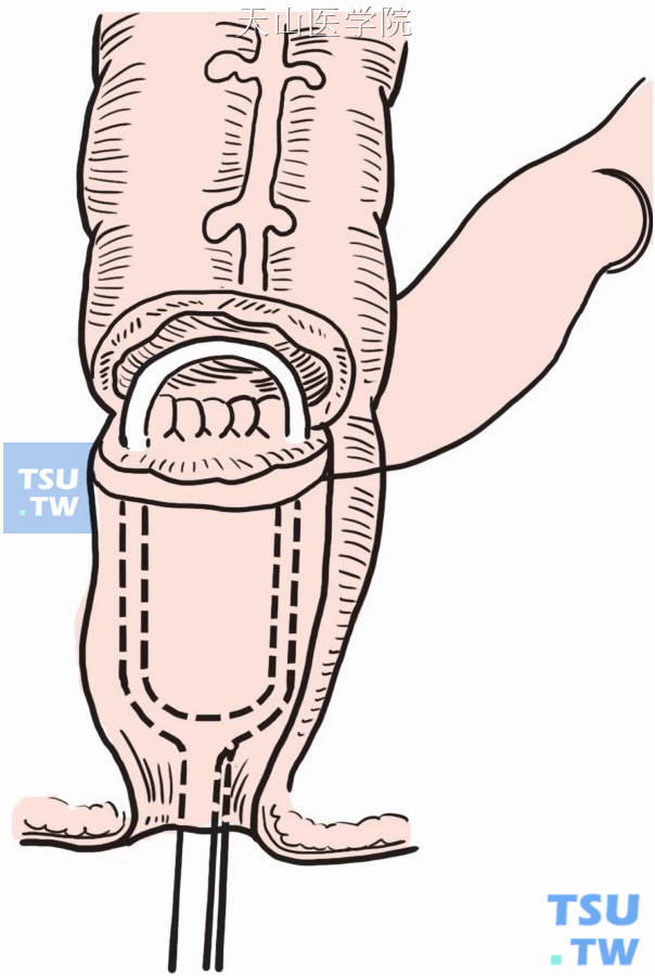 钳夹器钳夹整个直肠后壁和切口下方的结肠前壁