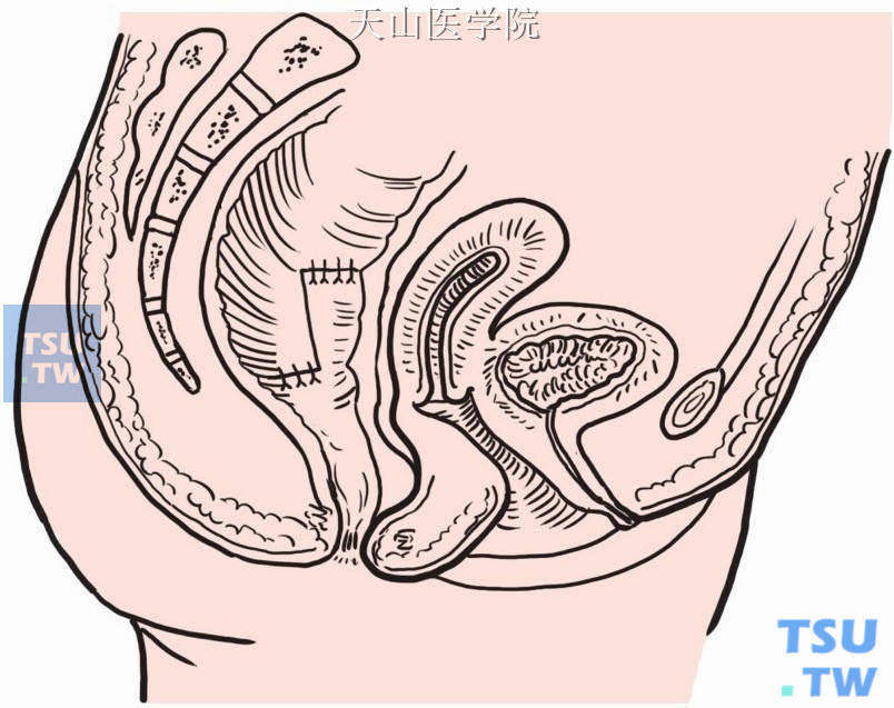 吻合口呈“Z”形