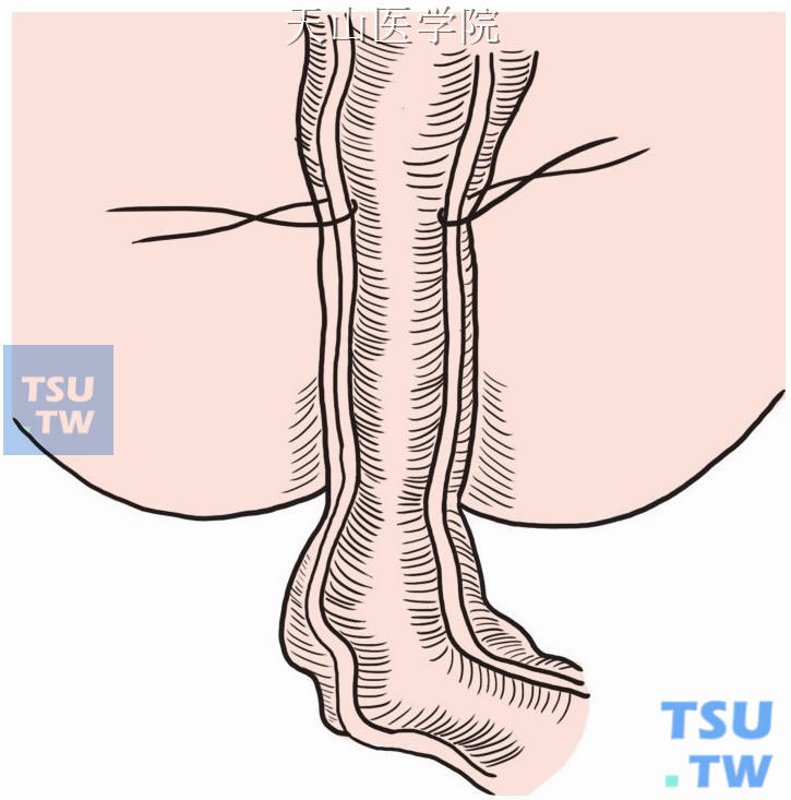 直肠浆肌层残端与结肠壁间断缝合