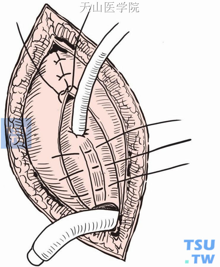 巴氏腺囊肿造口术步骤图片