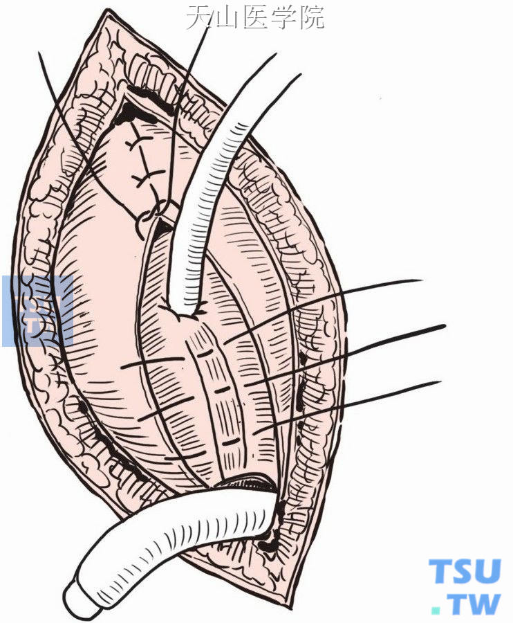 缝闭腹膜切口