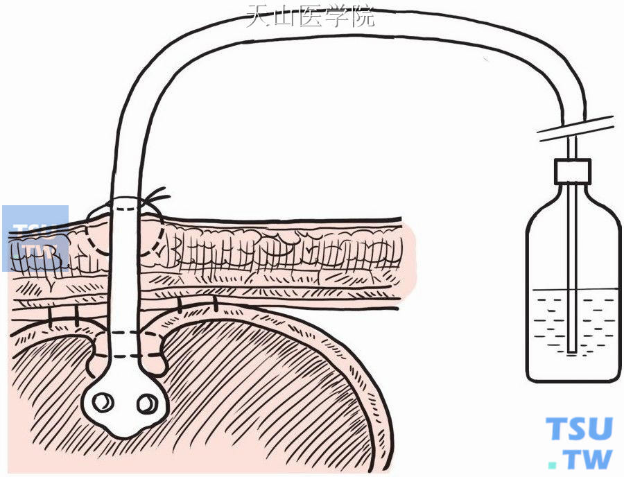 蕈状导尿管另接引流瓶