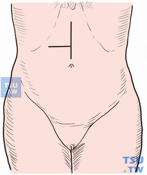 取右上腹横切口，其平面相当于剑突至脐孔间的中点或稍偏下方，也可取上腹部正中切口