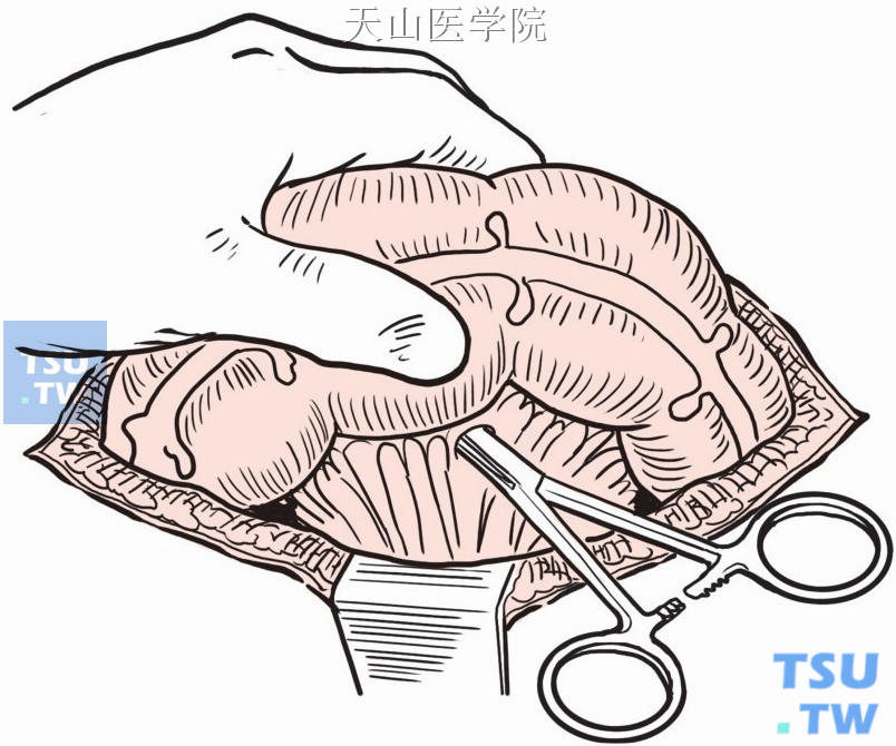 在横结肠系膜近肠壁处的无血管区戳孔