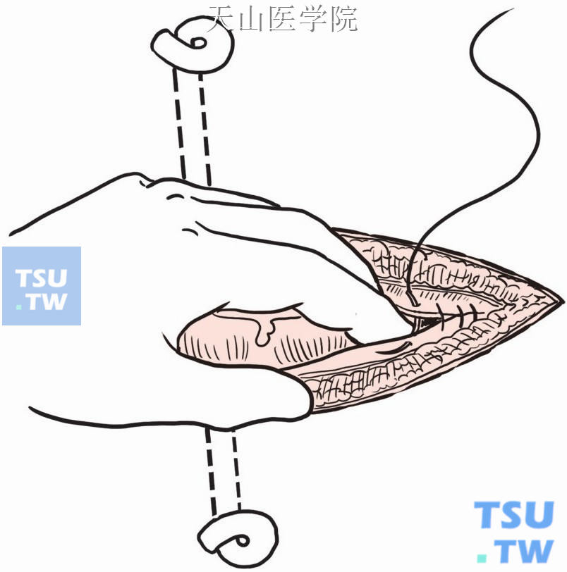 腹膜缝合