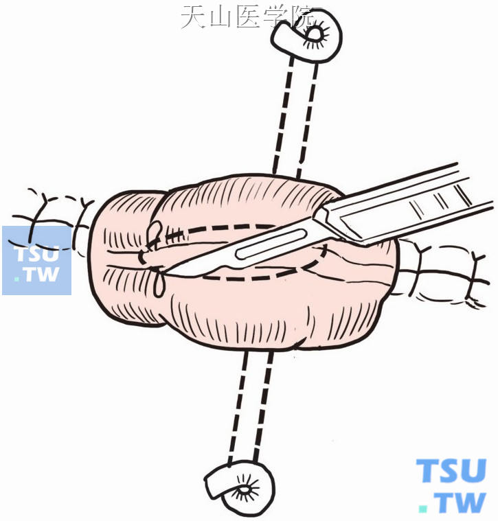 切除一块肠壁，形成襻式造口