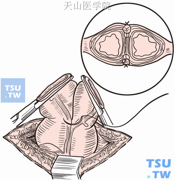 袢式造口的图片图片