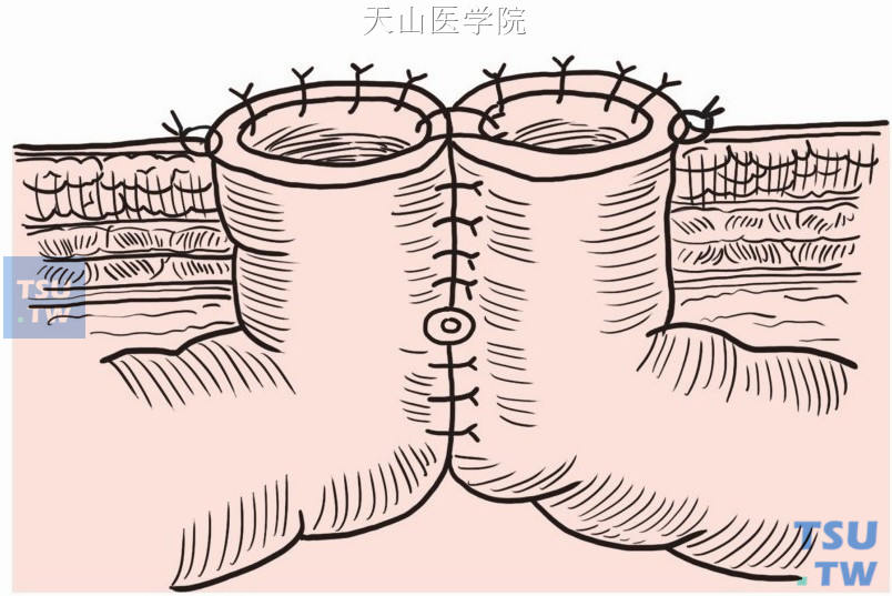 双腔造口示意图图片