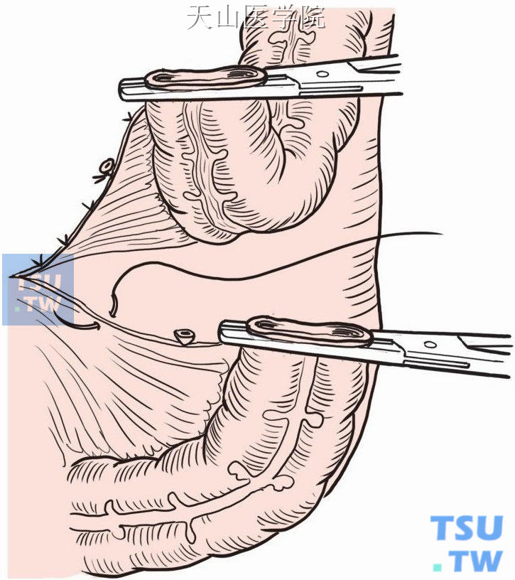 切断乙状结肠，适当游离肠系膜及侧腹膜