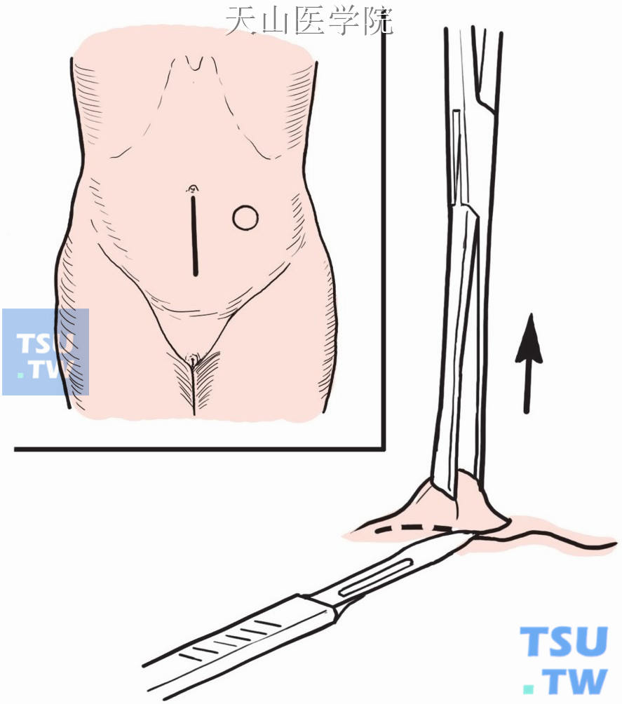 左下腹造口腹壁切割圆形切口