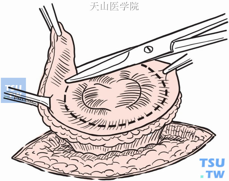 切除造口周围皮肤、皮下组织及瘢痕