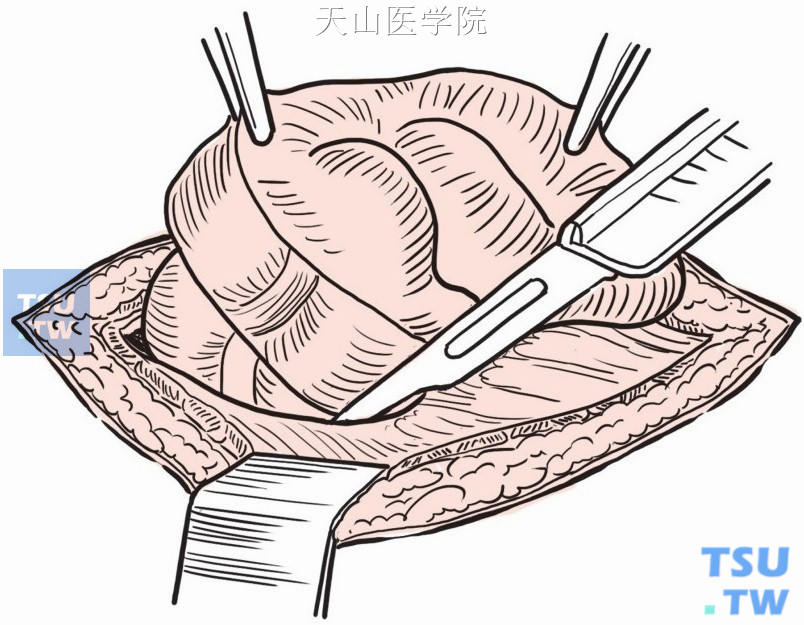 紧贴肠壁周围剪开腹膜