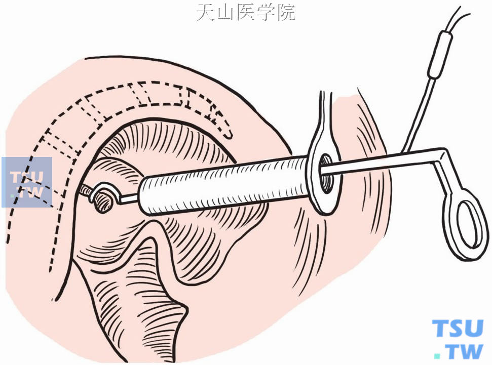 直肠腺瘤电套圈摘除术