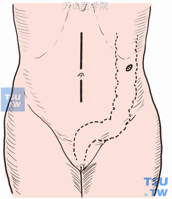 根据术前判定腺瘤的部位，选择上、下腹部绕脐正中切口或旁正中切口，按层进腹