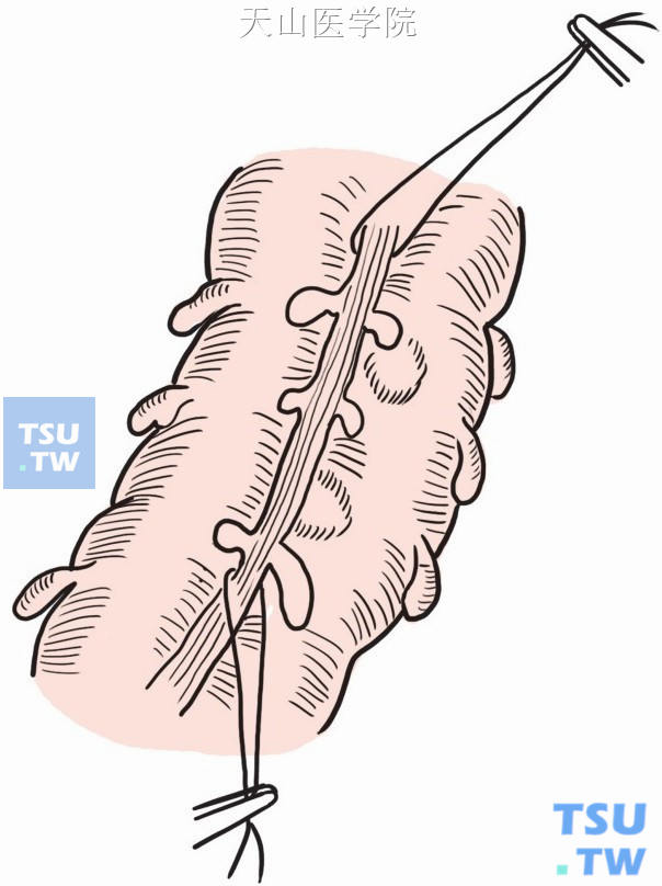 结肠切开和腺瘤切除术