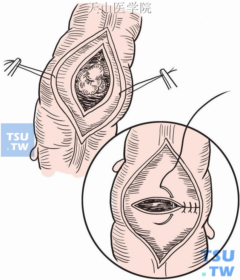 切除腺瘤，粘膜缝合