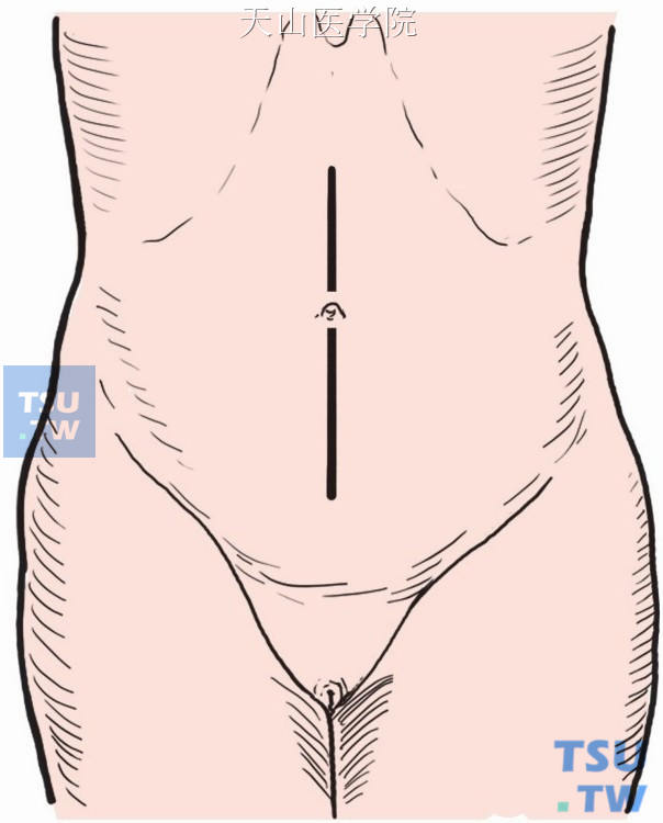 取腹部正中切口，自耻骨联合至上腹剑突与脐孔之中点