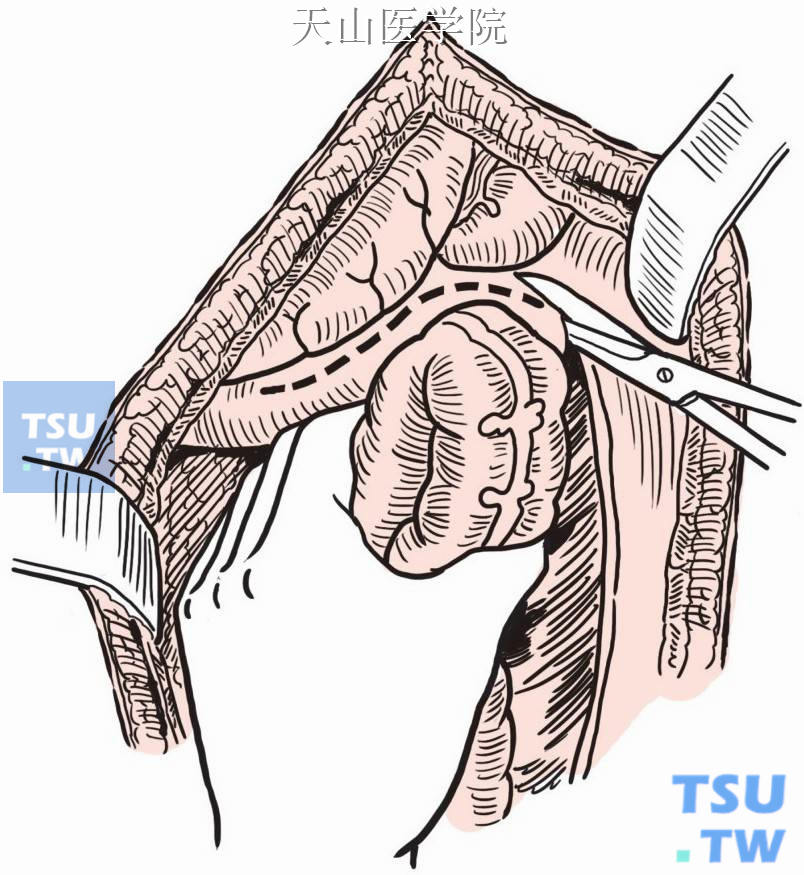 沿降结肠向上游离脾曲