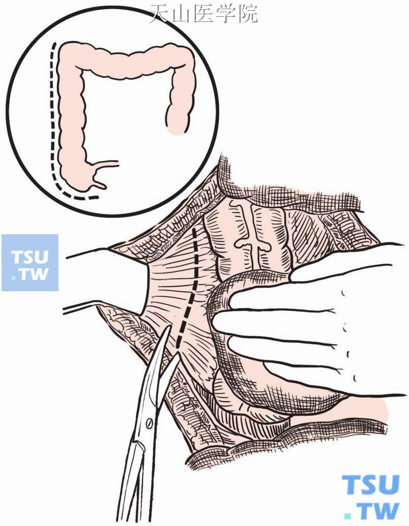 切开右侧结肠旁腹膜