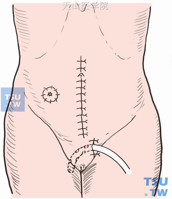 引流管自腹部切口下端引出