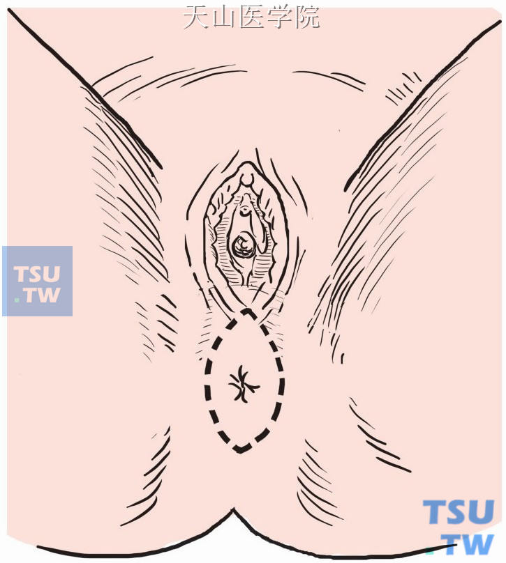 会阴部肛门周围梭形切口