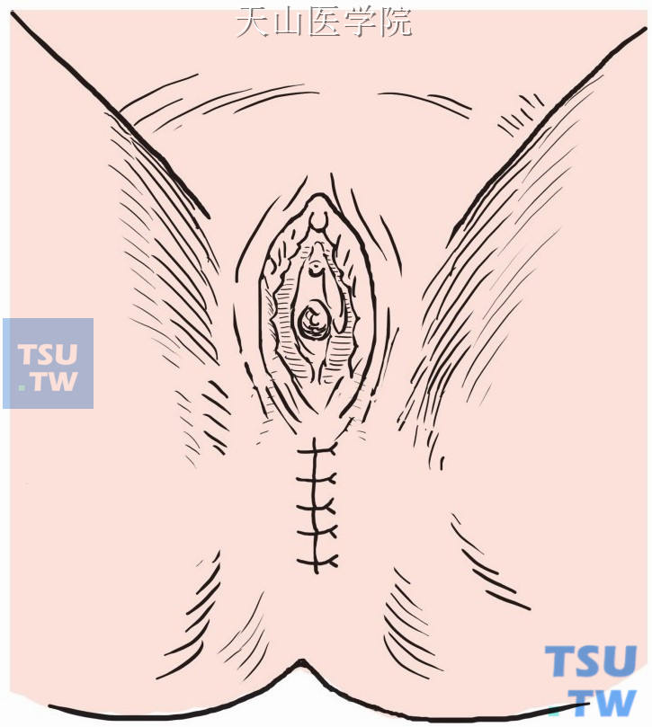 会阴伤口缝闭