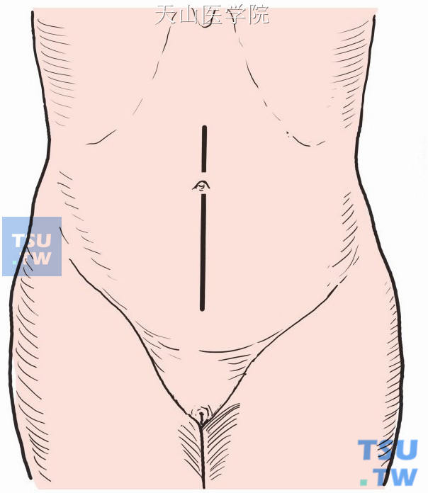 进腹后放置切口保护圈，全面探查确定有无肉眼或触及可疑的原发病灶与转移灶