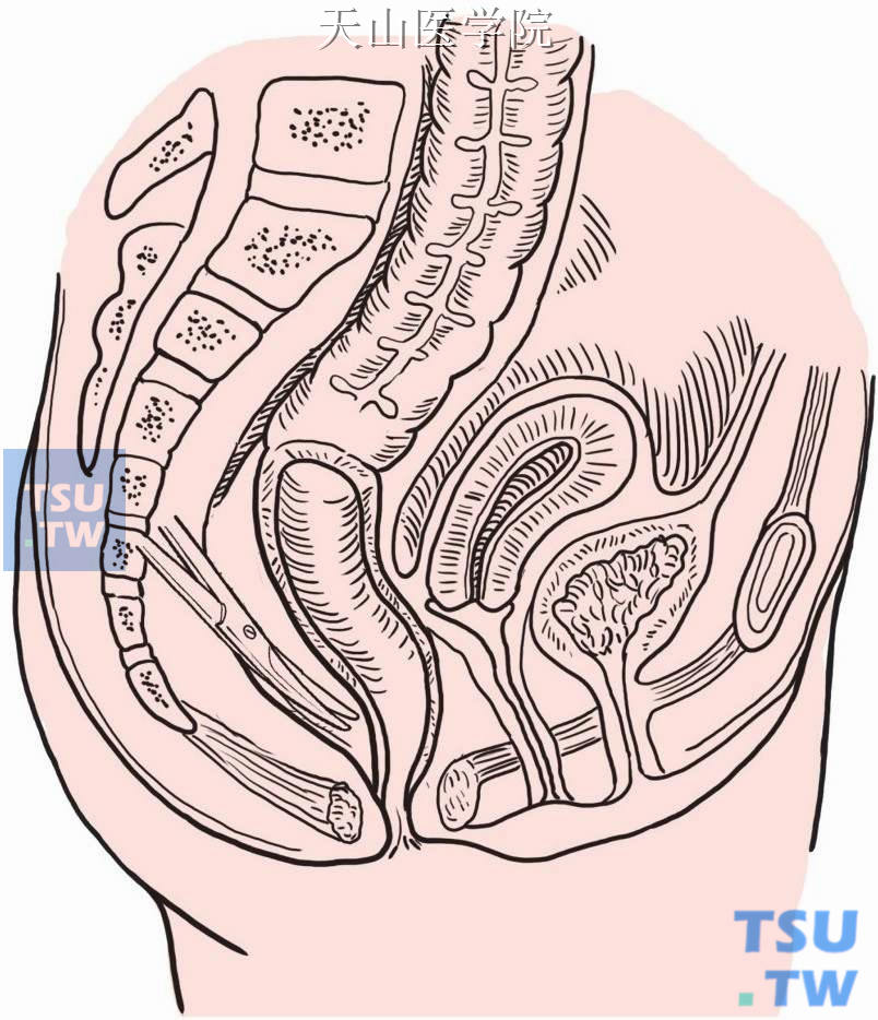 骶前间隙游离直肠达肛提肌平面