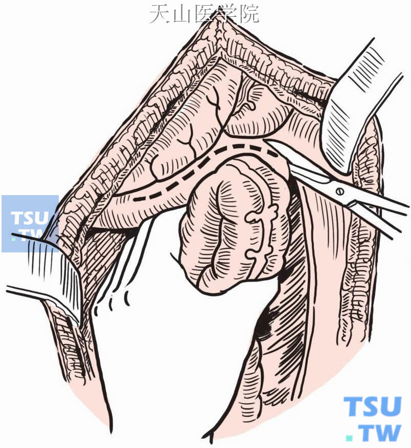 沿降结肠向上游离脾曲