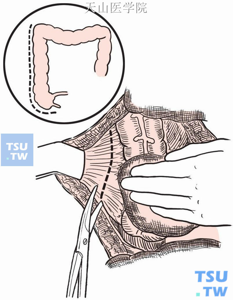 切开右侧结肠旁腹膜，游离右侧结肠和末端回肠