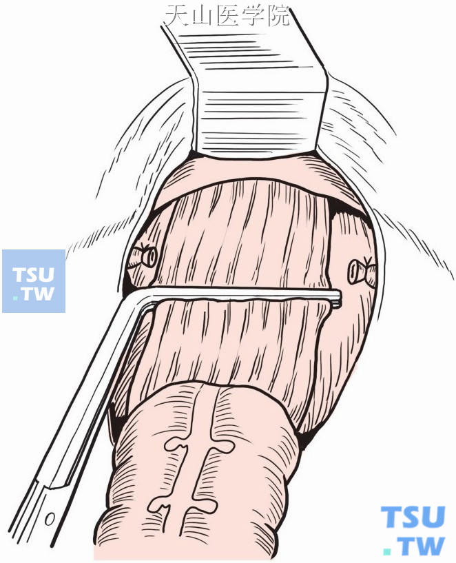 直角钳阻断直肠腔