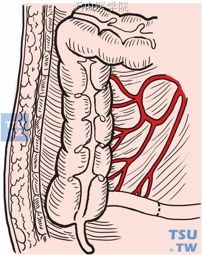 距回盲瓣5～6cm处切断末段回肠